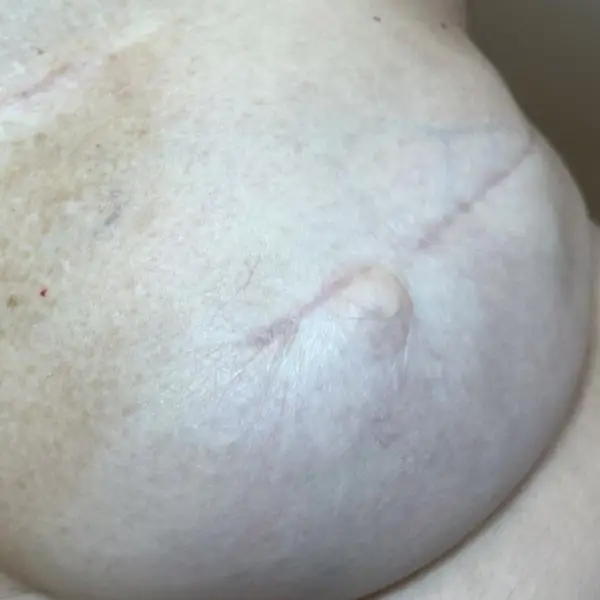 Reconstrucción areola mamaria con micropigmentación