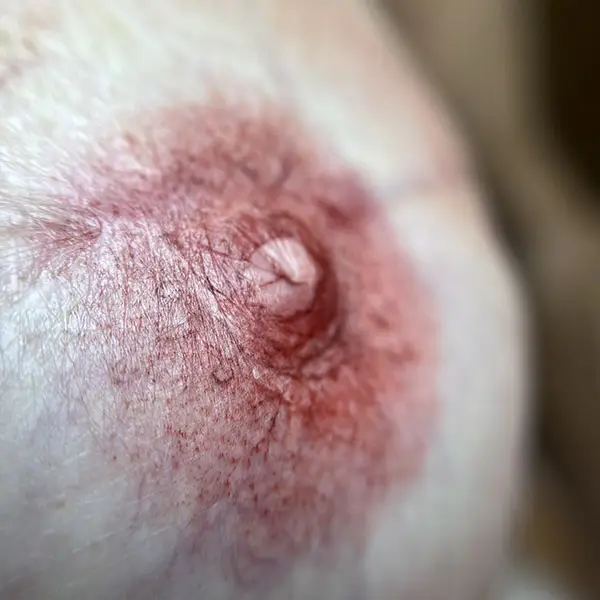 Reconstrucción areola mamaria con micropigmentación