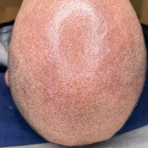 Micropigmentación capilar en Sevilla