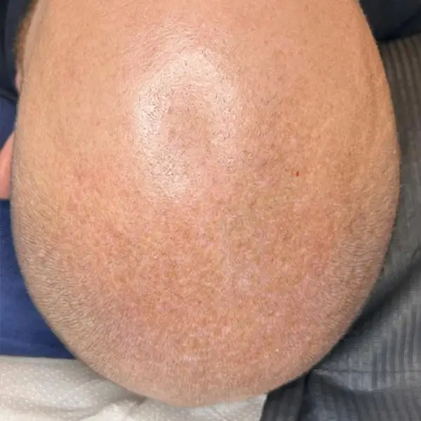 Micropigmentación capilar en Sevilla