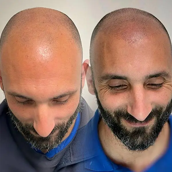 Micropigmentación capilar Iryna Nyk